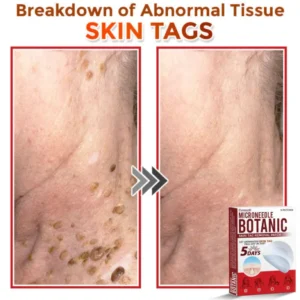 Cvreoz® MicroNeedle Botanic Skin Tag Removal Patch 9 Cvreoz® MicroNeedle Botanic Skin Tag Removal Patch