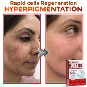 Cvreoz® MicroNeedle Botanic Skin Tag Removal Patch 8 Cvreoz® MicroNeedle Botanic Skin Tag Removal Patch