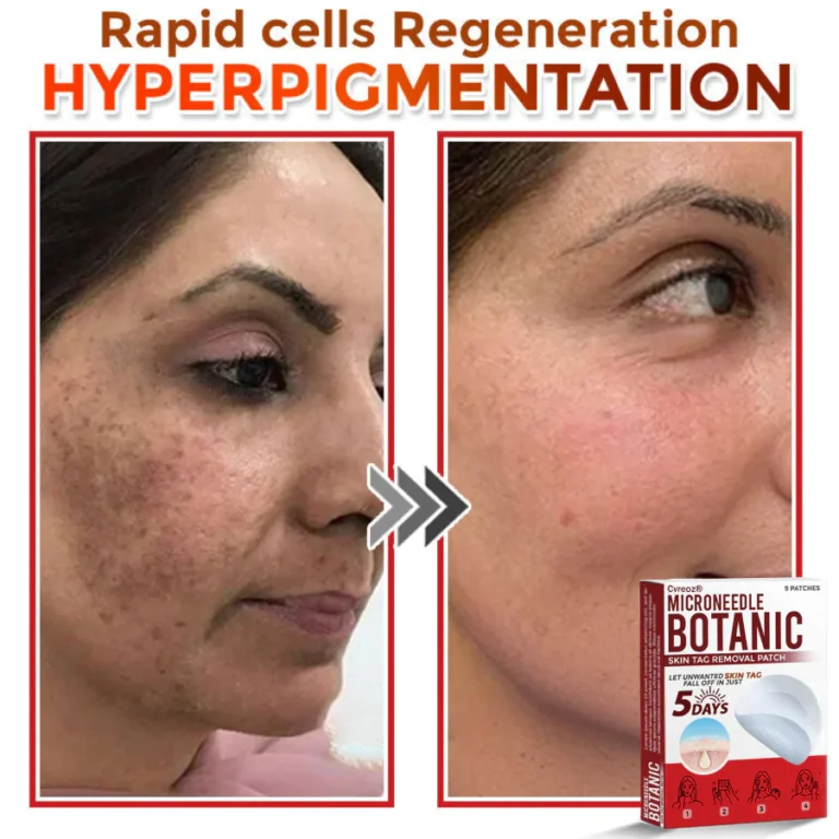 Cvreoz® MicroNeedle Botanic Skin Tag Removal Patch 4 Cvreoz® MicroNeedle Botanic Skin Tag Removal Patch