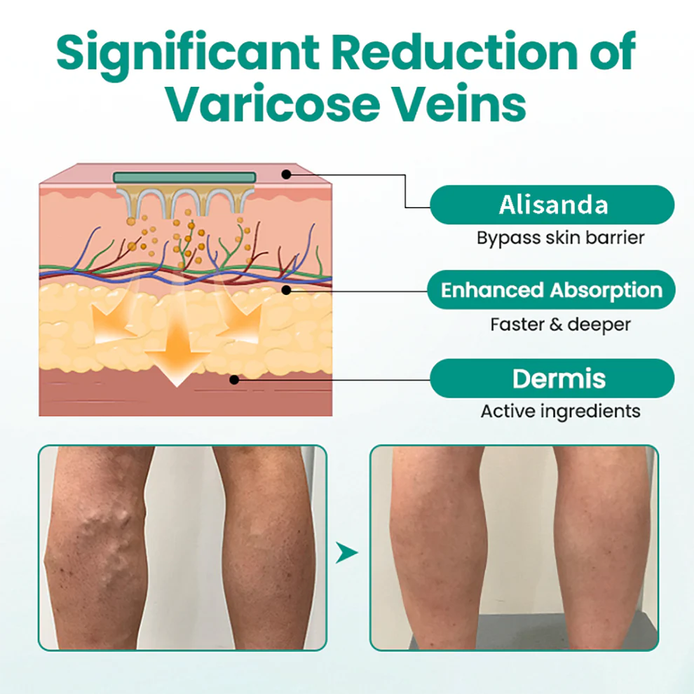 Alisanda® Varicose Veins Patch