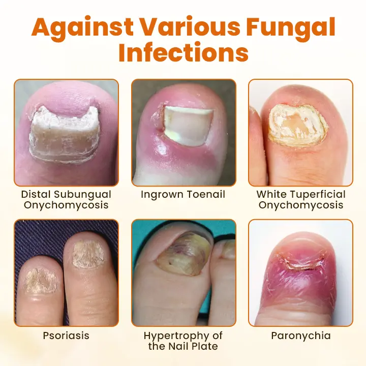 Alisanda® FungiBee Advanced Nail Repair Spray 5 Alisanda® FungiBee Advanced Nail Repair Spray