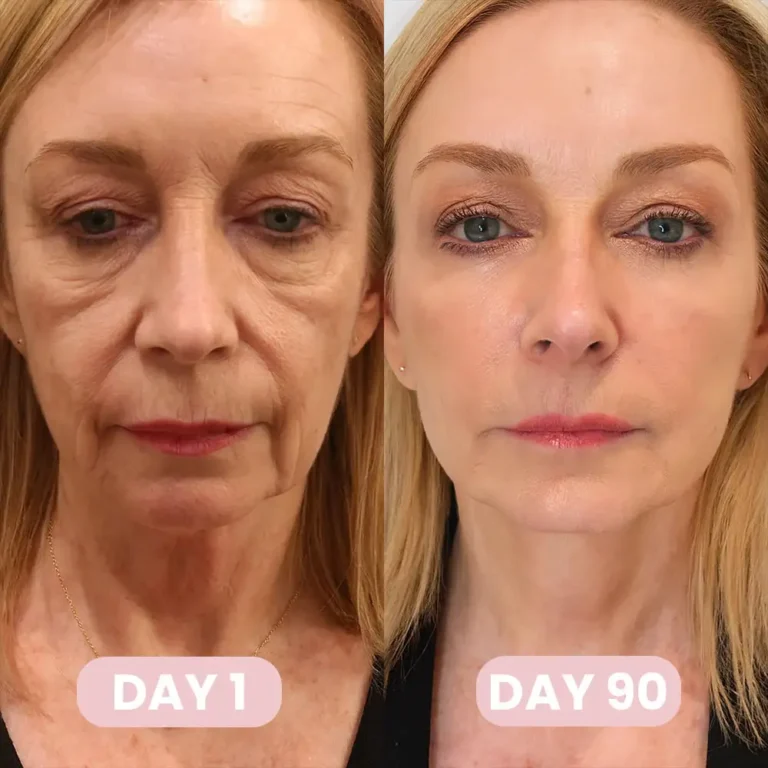 Alisanda™ GLP-1 Patches